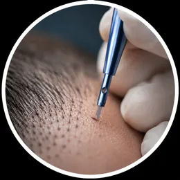 FUE Saphir Haartransplantation in Hannover