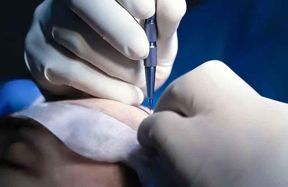 Moderne Haartransplantation Klinik in Hannover